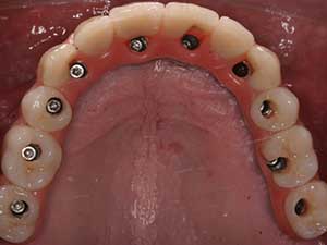 DentalImplants1
